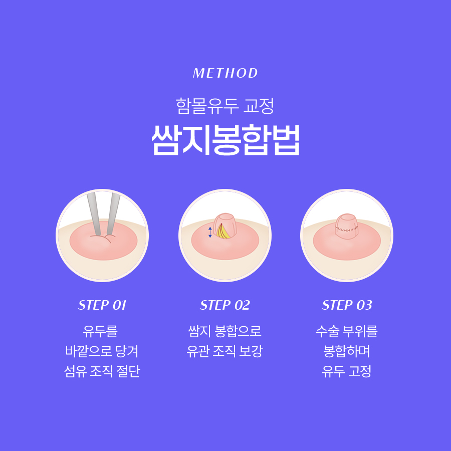함몰유두성형 기능적인 이유로도 고려해야 하는 이유 관련 이미지 5