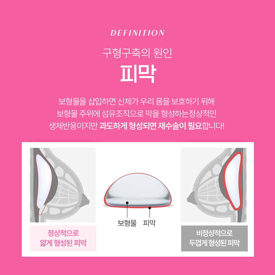 구형구축재수술방법 보형물 교체만으로 끝나지 않는 이유 관련 이미지 4