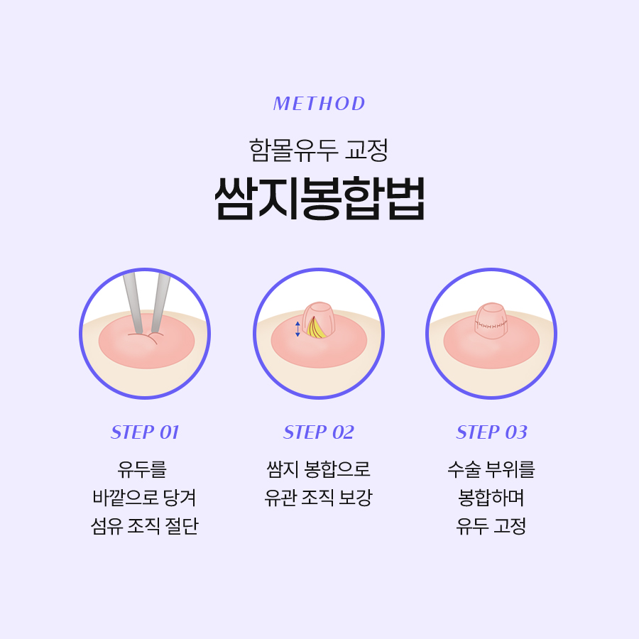 함몰유두교정술 적합한 수술방법은? 관련 이미지 5