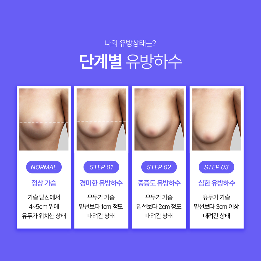 처진가슴수술비용, 처짐 정도에 따른 교정방법 관련 이미지 4