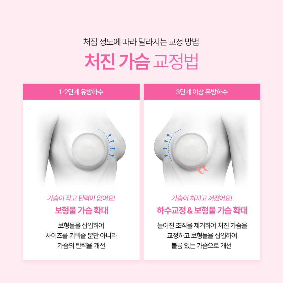 처진가슴교정술 가슴 탄력 개선을 위한 방법 관련 이미지 5
