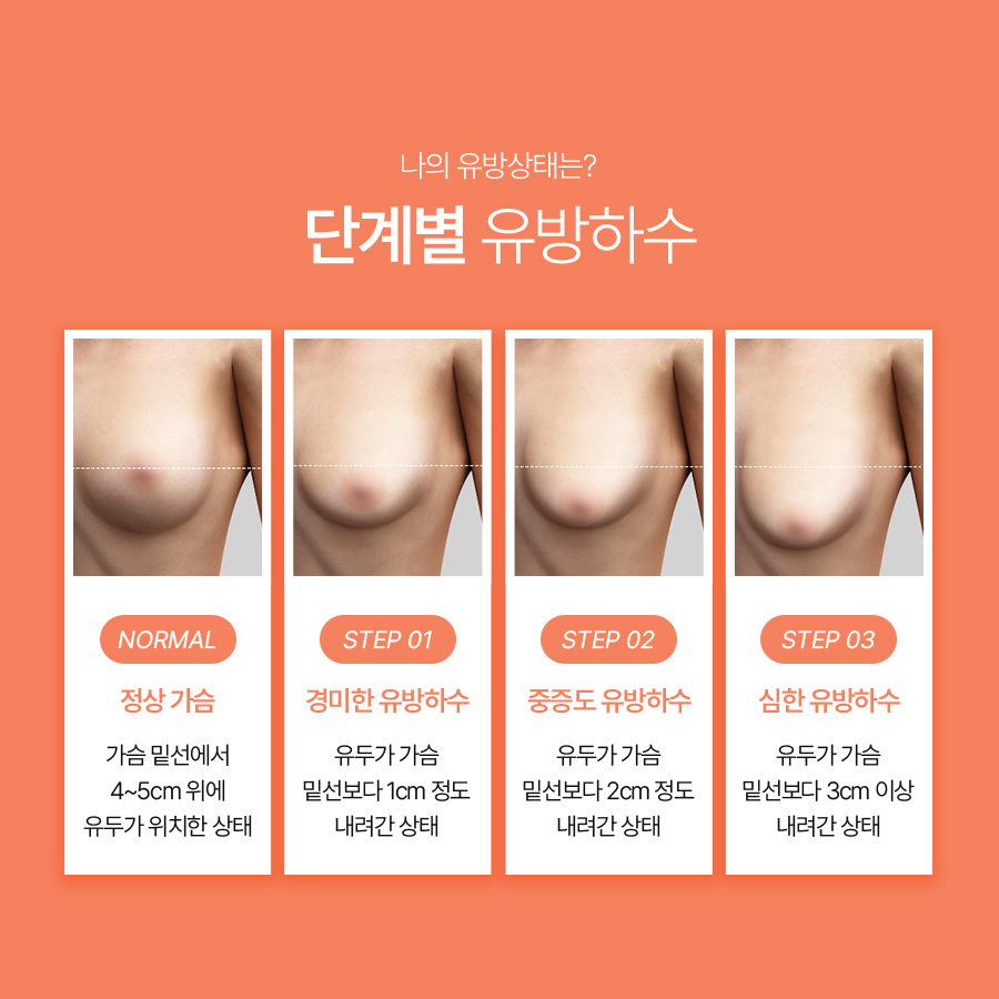 유방하수교정수술, 보형물만으로 해결되지 않는 가슴 처짐 관련 이미지 4