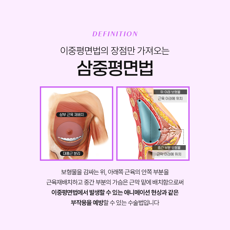 가슴확대성형 수술 시 고려해야 하는 부분은? 관련 이미지 6