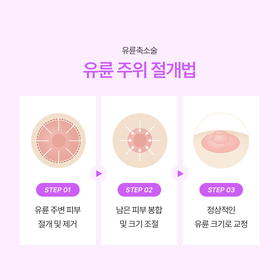 유두교정술병원 입체적인 가슴의 완성은 유륜축소부터 관련 이미지 5