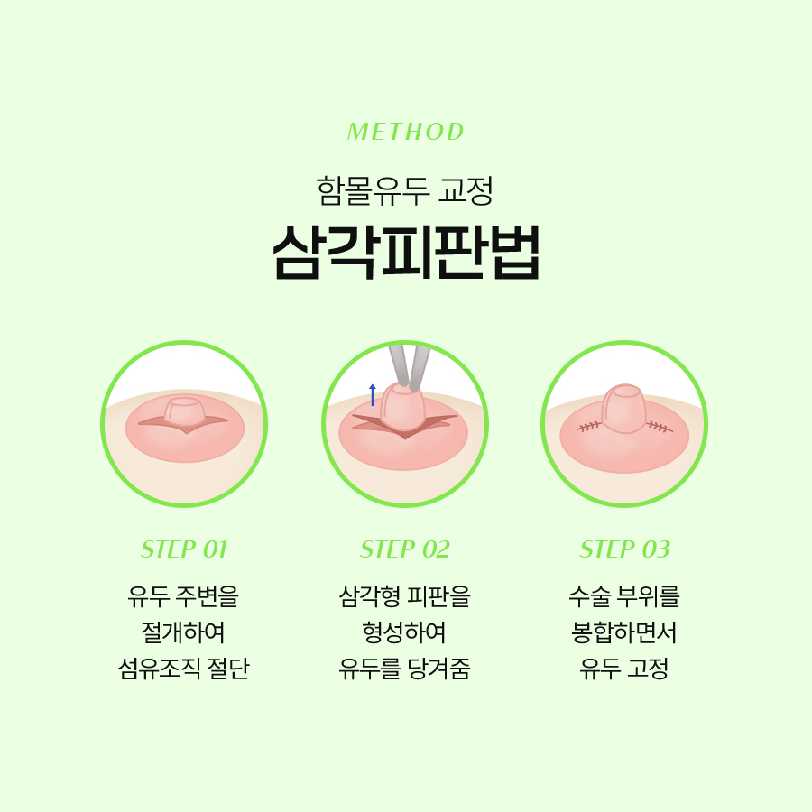 여성함몰유두교정, 다시 함몰되지 않으려면 확인해야 할 부분 관련 이미지 4