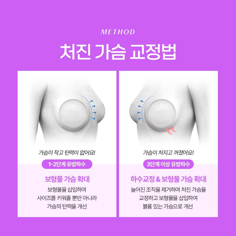 유방하수교정수술 고려 전 가슴 변화 원리 정리 관련 이미지 5