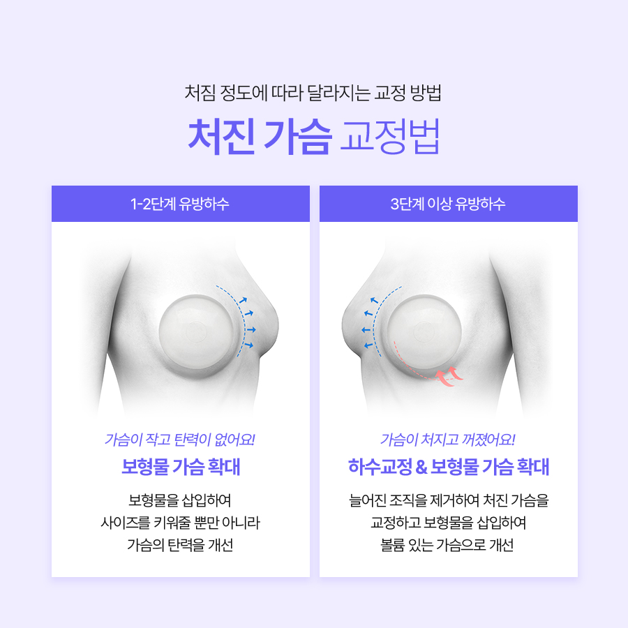 처진가슴보형물수술 체형 균형을 고려한 방법 관련 이미지 5