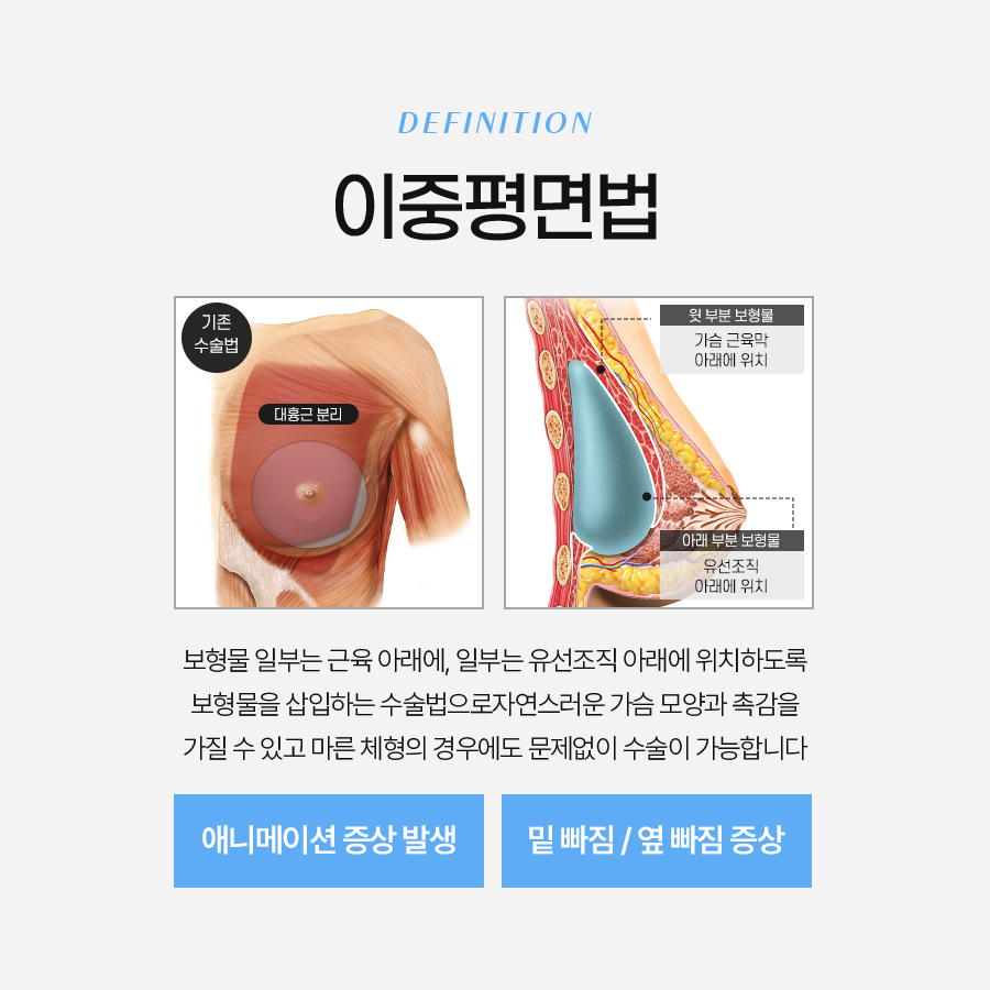 가슴 볼륨 수술 나에게 맞는 방법과 종류 총정리 관련 이미지 4