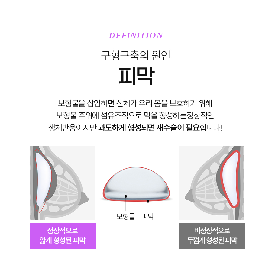 Revision Surgery for Breast Capsular Contracture: A Complete Solution for Natural Results image 4