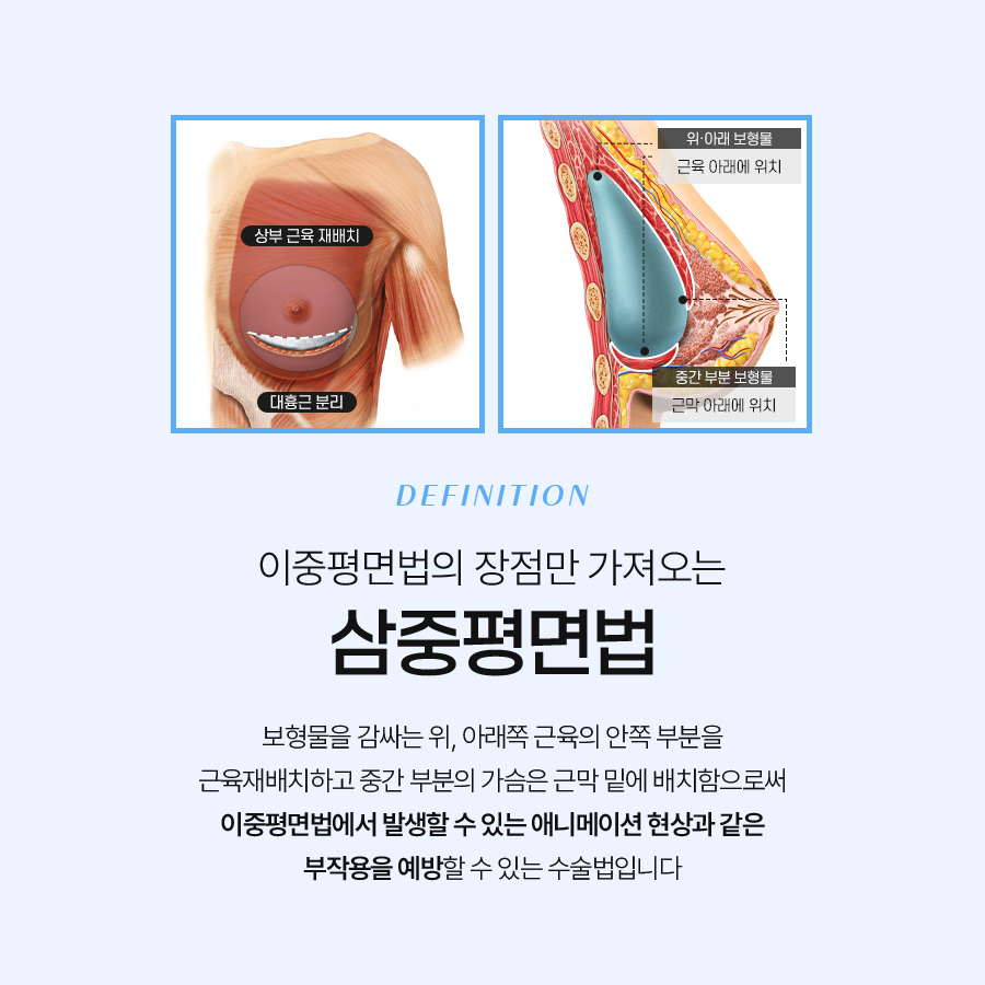 Criteria for Choosing a Breast Augmentation Surgery Based on Body Type image 3