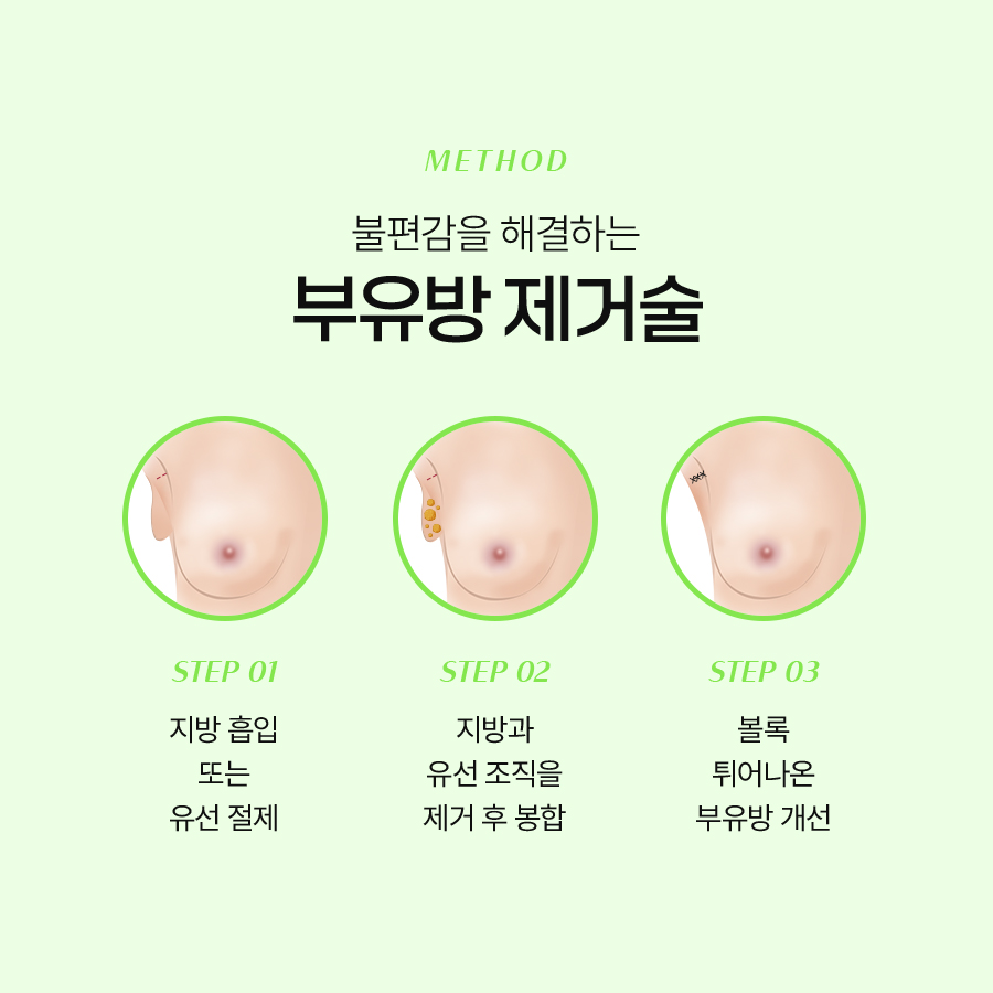 Accessory Breast Fat Removal: A Look at Accessory Breast Correction Considering Upper-Body Proportions image 5