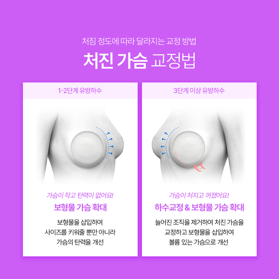 유방하수수술 병원, 처진 가슴 수술 전 확인해야 할 점 관련 이미지 5