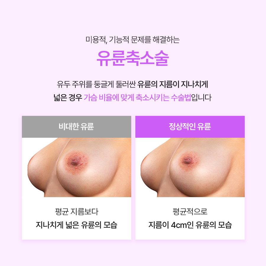 유두교정술병원 입체적인 가슴의 완성은 유륜축소부터 관련 이미지 3
