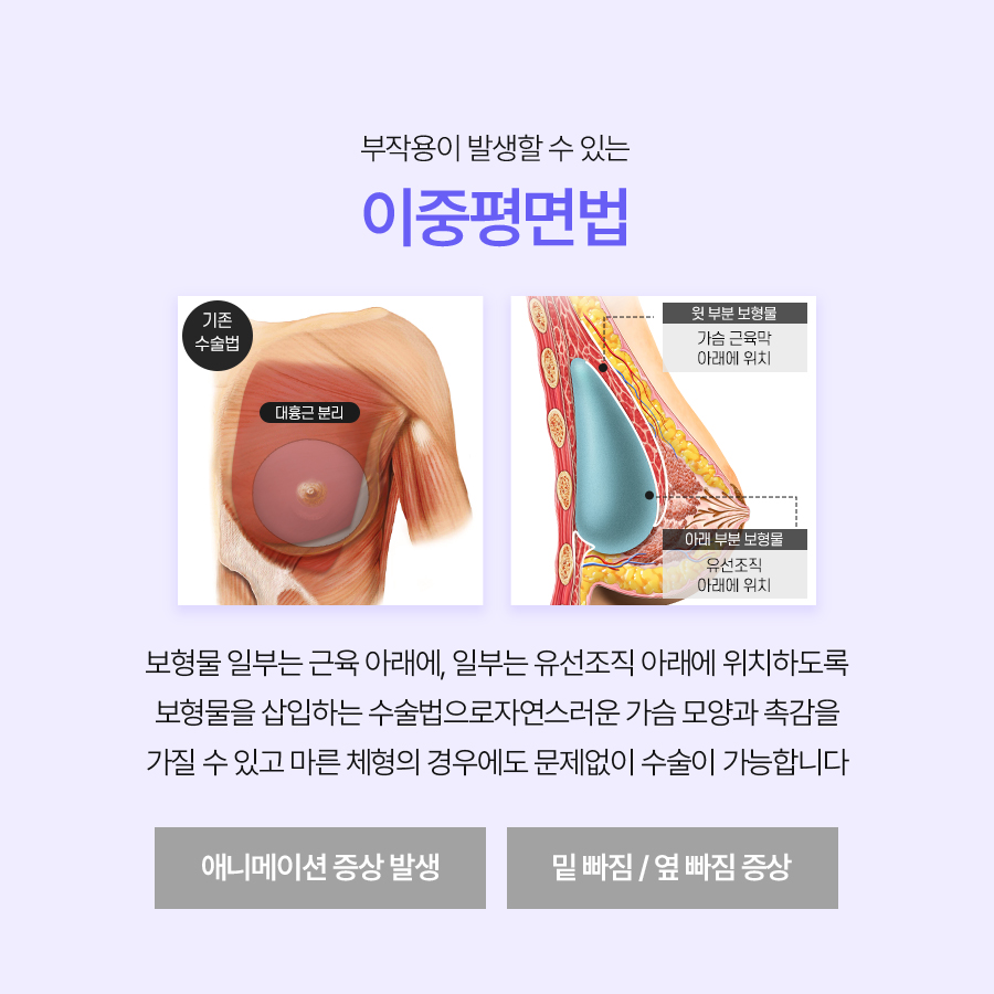 가슴수술잘하는병원 자연스러운 움직임을 고려한 가슴수술 방식 비교 관련 이미지 3