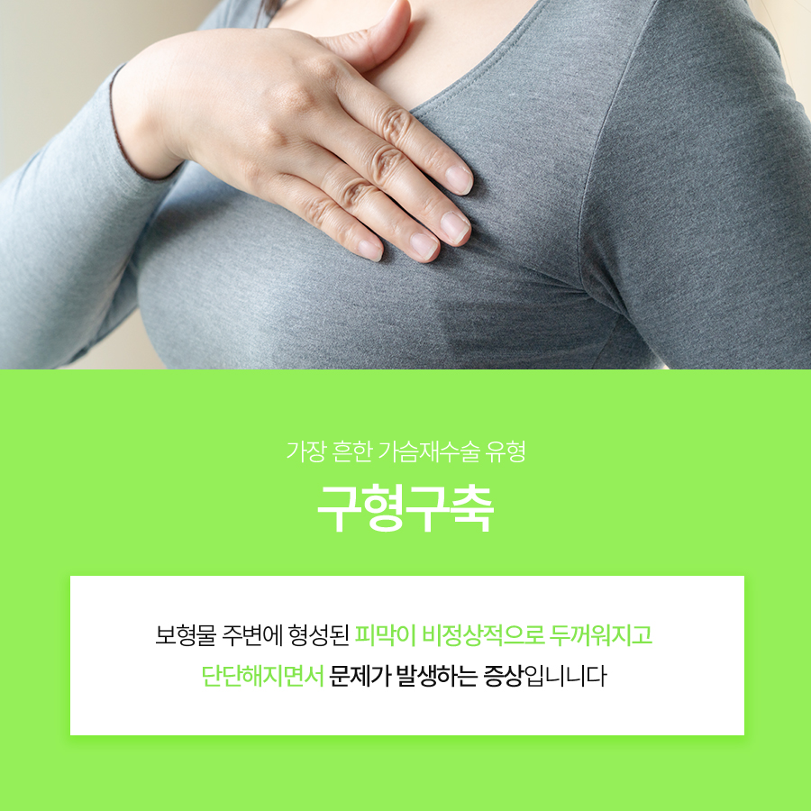 가슴구형구축재수술, 개인별 원인에 맞춘 계획이 중요한 이유 관련 이미지 3