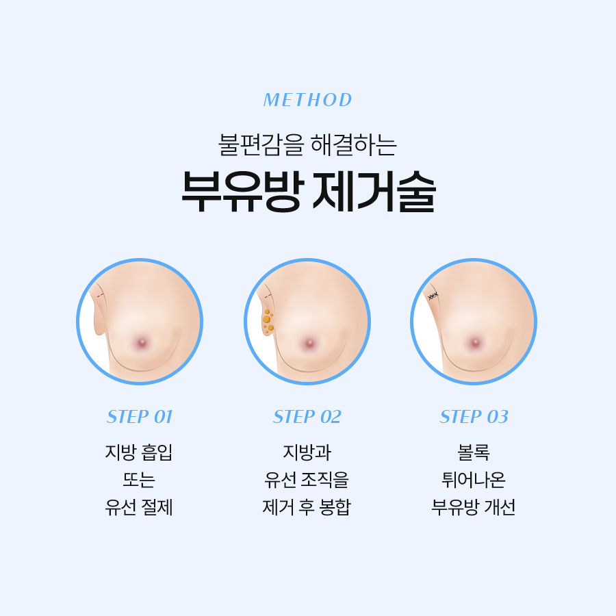 뷰유방 지방제거 라인 정리가 중요한 이유 관련 이미지 4