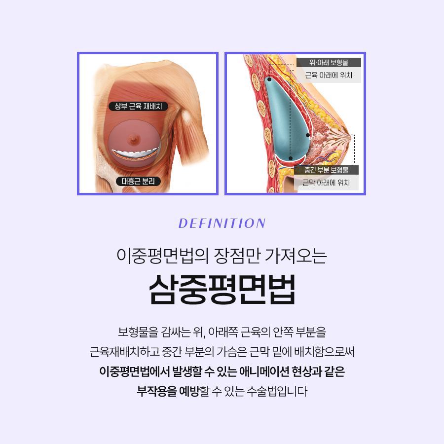 애니메이션 현상 고민이라면? 삼중평면법으로 교정하기 관련 이미지 5