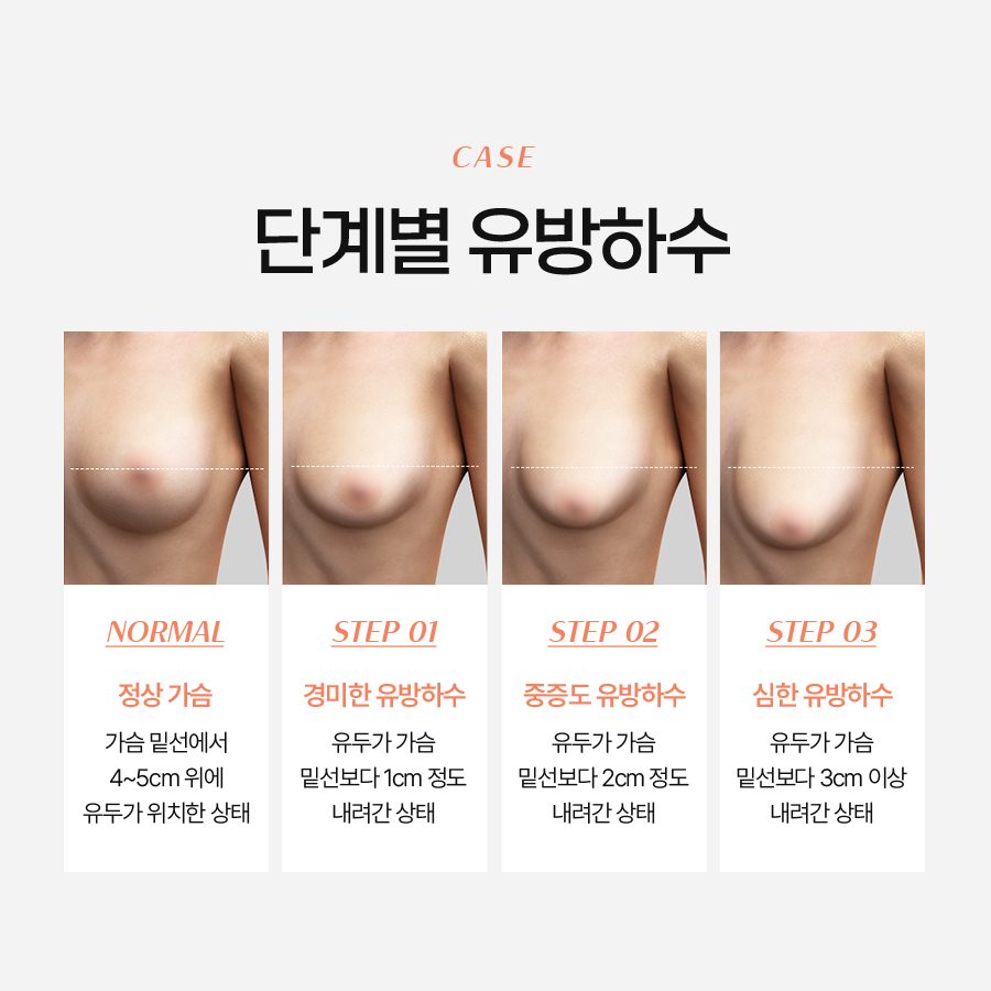 유방하수 교정수술, 언제 필요하고 어떻게 진행될까? 관련 이미지 4