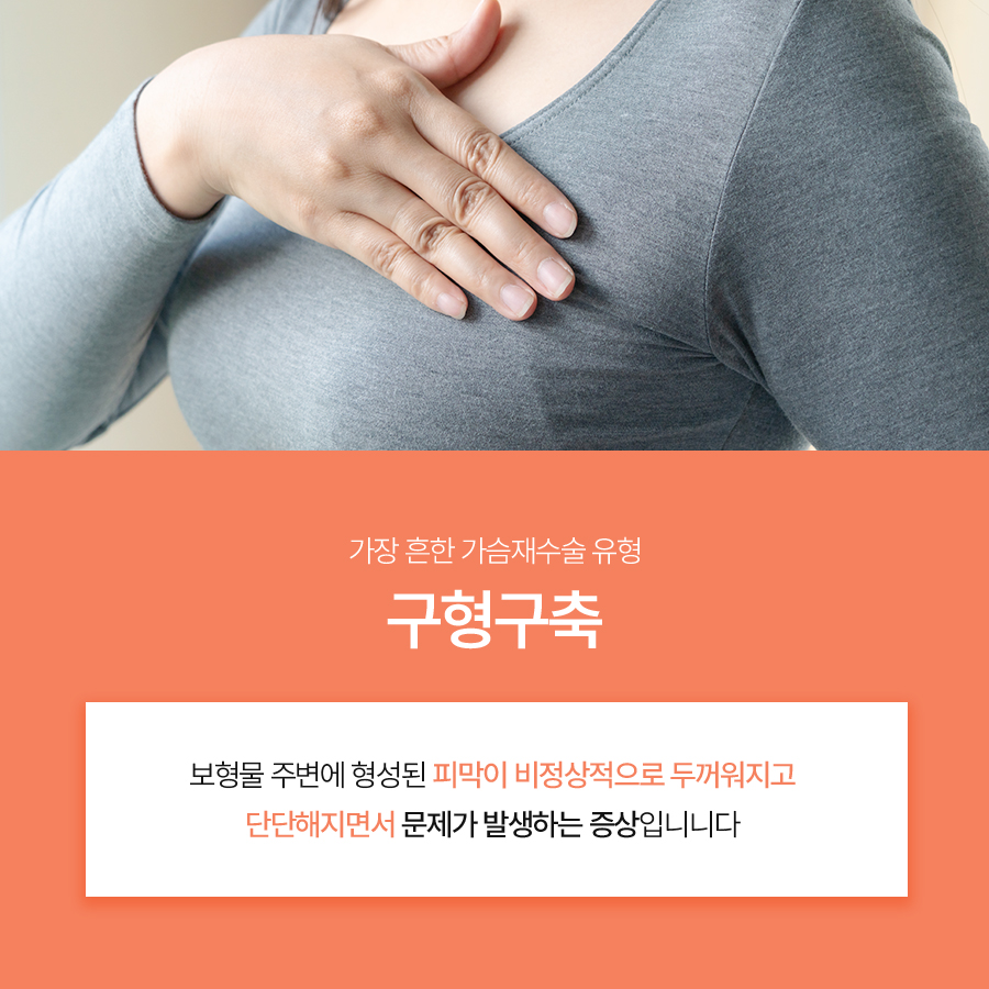 Why Planning Must Be Different for Breast Revision Surgery Due to Capsular Contracture image 3