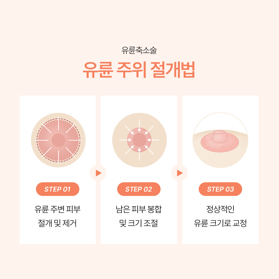 가슴유륜축소술방법 이상적인 유륜 비율을 만드는 기준은? 관련 이미지 5