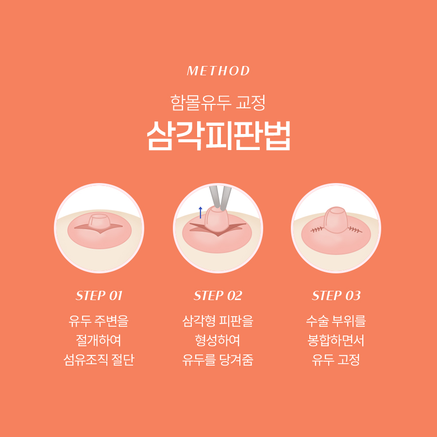 함몰유두교정수술 어떻게 진행될까? 관련 이미지 4