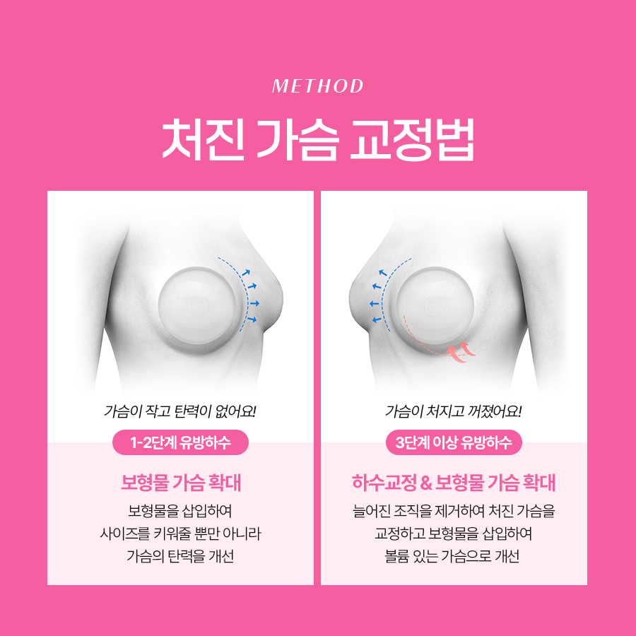 처진가슴수술비용 처짐 정도에 따라 달라지는 교정 방법 관련 이미지 5