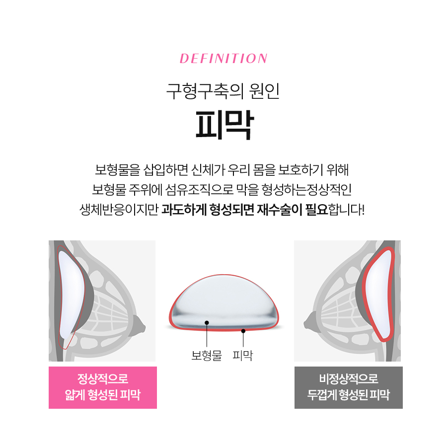 가슴구형구축 원인 정확히 파악해야 관련 이미지 4