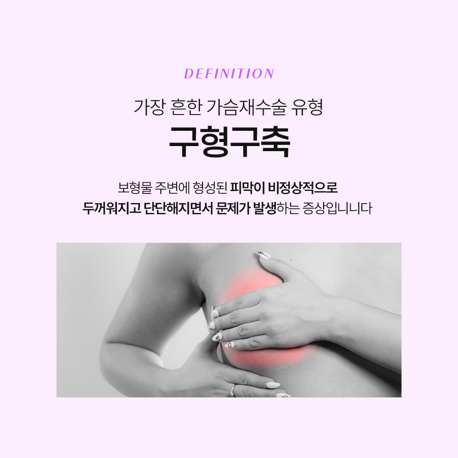 Revision Surgery for Breast Capsular Contracture: A Complete Solution for Natural Results image 3