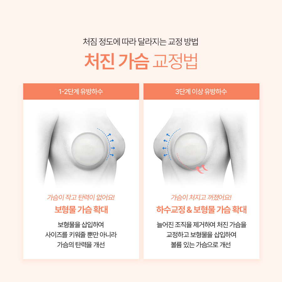 가슴처짐 교정수술 탄력과 라인 개선의 핵심 관련 이미지 5