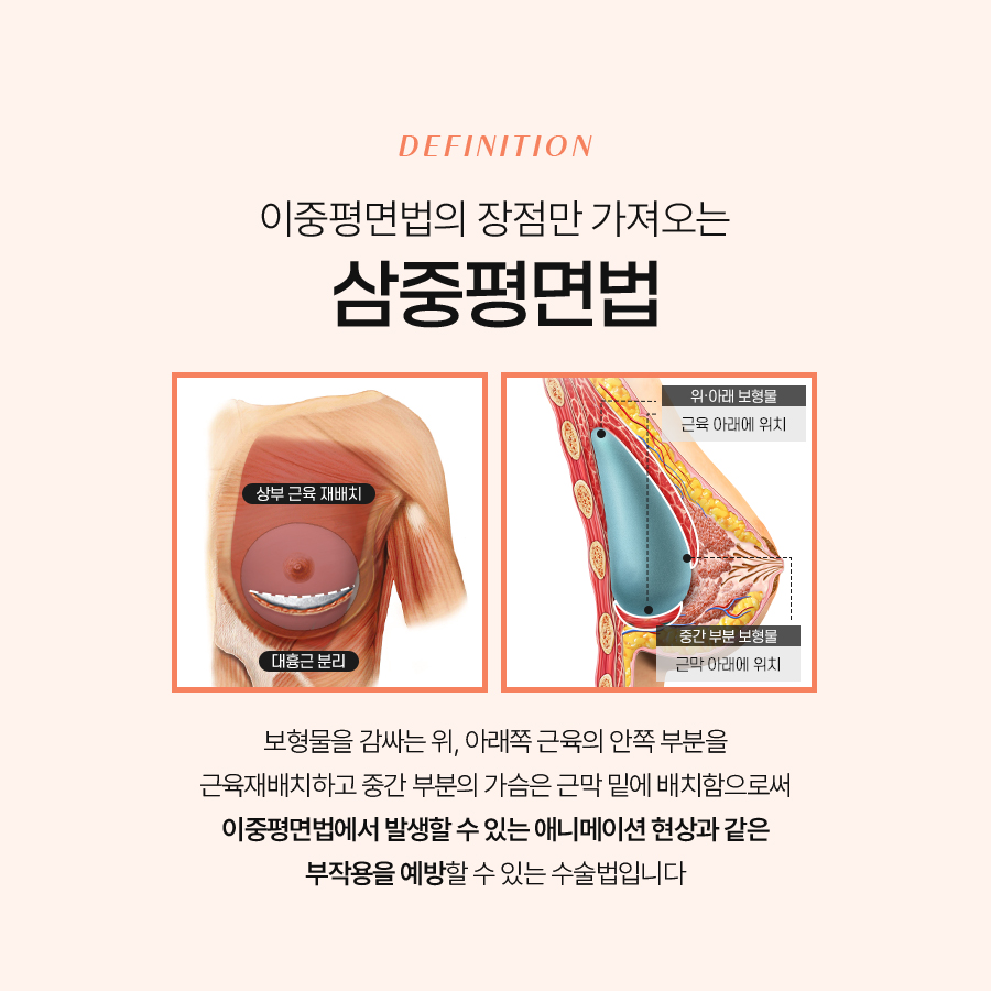 가슴구형구축원인 예방하기 위한 방법은? 관련 이미지 4