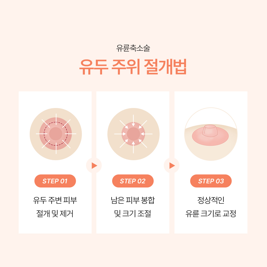 가슴유륜축소술방법 이상적인 유륜 비율을 만드는 기준은? 관련 이미지 4