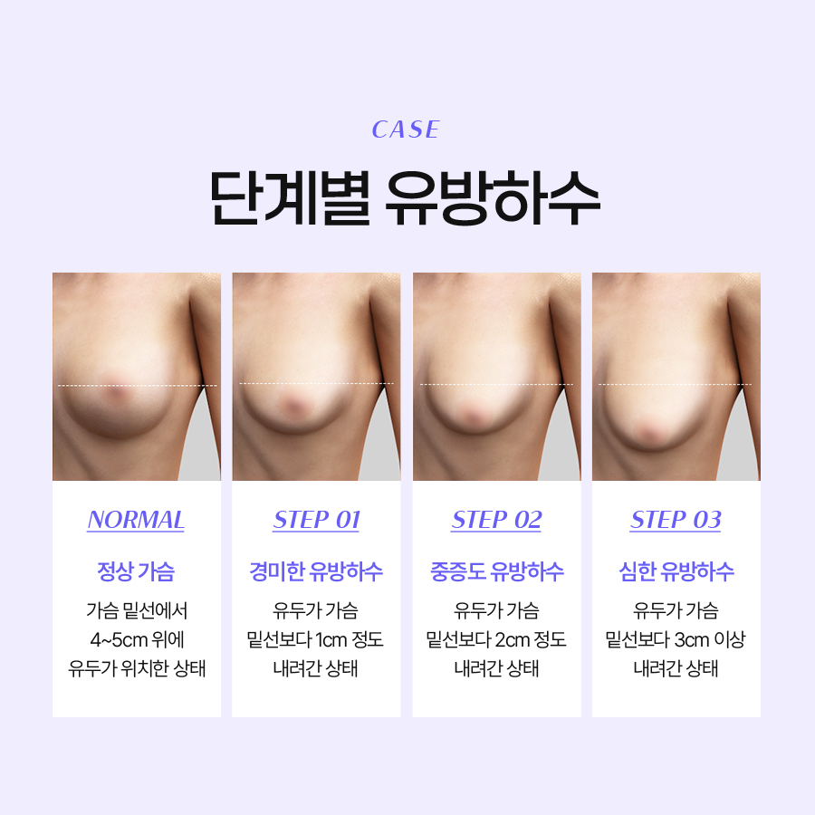 Understanding the Causes of Breast Sagging Is the First Step in Preventing Breast Ptosis image 4