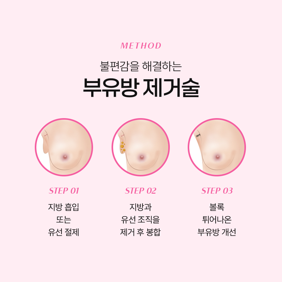 How Axillary Accessory Breast Correction Surgery Creates a Smooth Side Line image 5