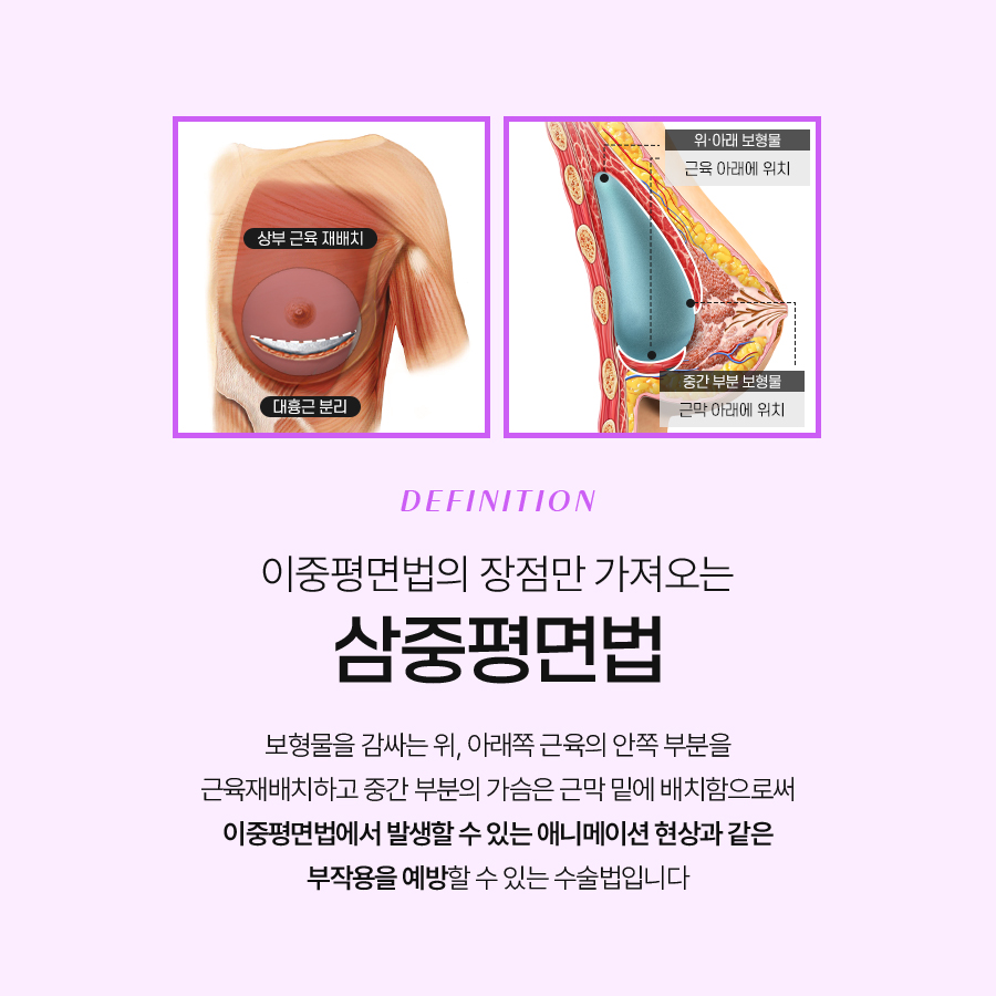 가슴성형잘하는병원 평면별 수술 접근 방식 관련 이미지 4