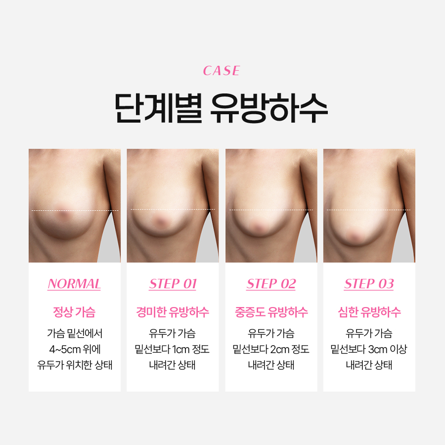 중년가슴성형 처진 가슴 자연스럽게 되돌리는 방법 관련 이미지 4