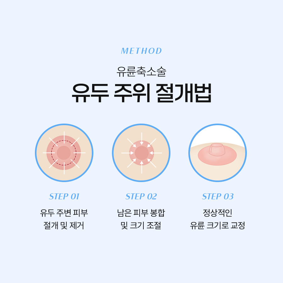 가슴유륜축소수술 꼭 알아야 할 모든 것 관련 이미지 4