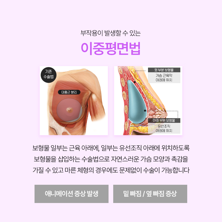 가슴재수술방법, 삼중평면법의 특징과 절개법 확인 관련 이미지 3