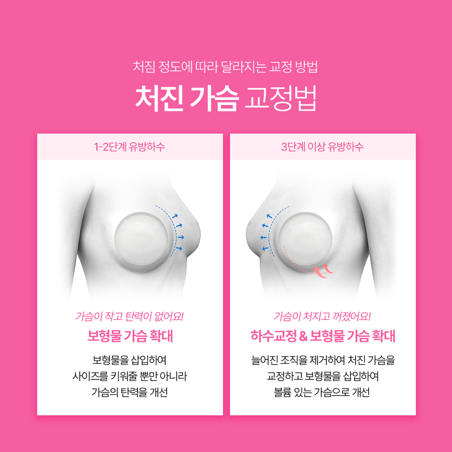 Breast Sagging Correction Surgery: Correction Methods Based on the Degree of Breast Ptosis image 5