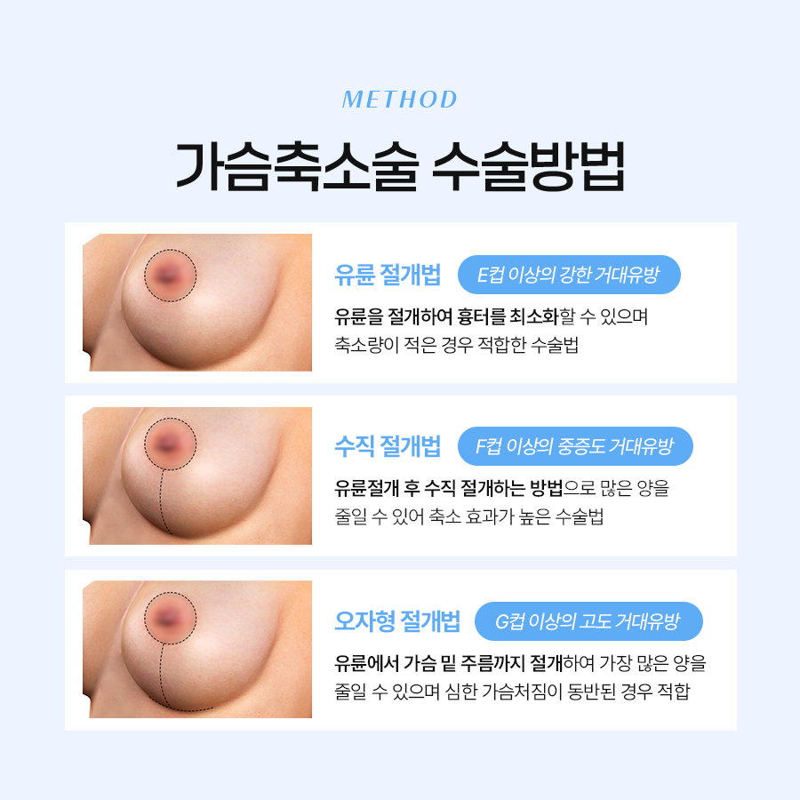 가슴축소성형수술 자연스러운 결과를 원한다면 관련 이미지 4