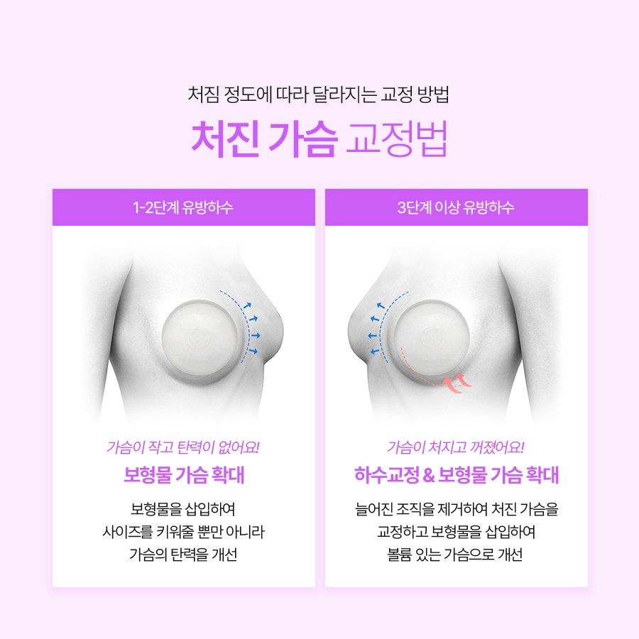 중년가슴성형 처진 가슴 개선으로 되찾는 상체 라인 관련 이미지 5
