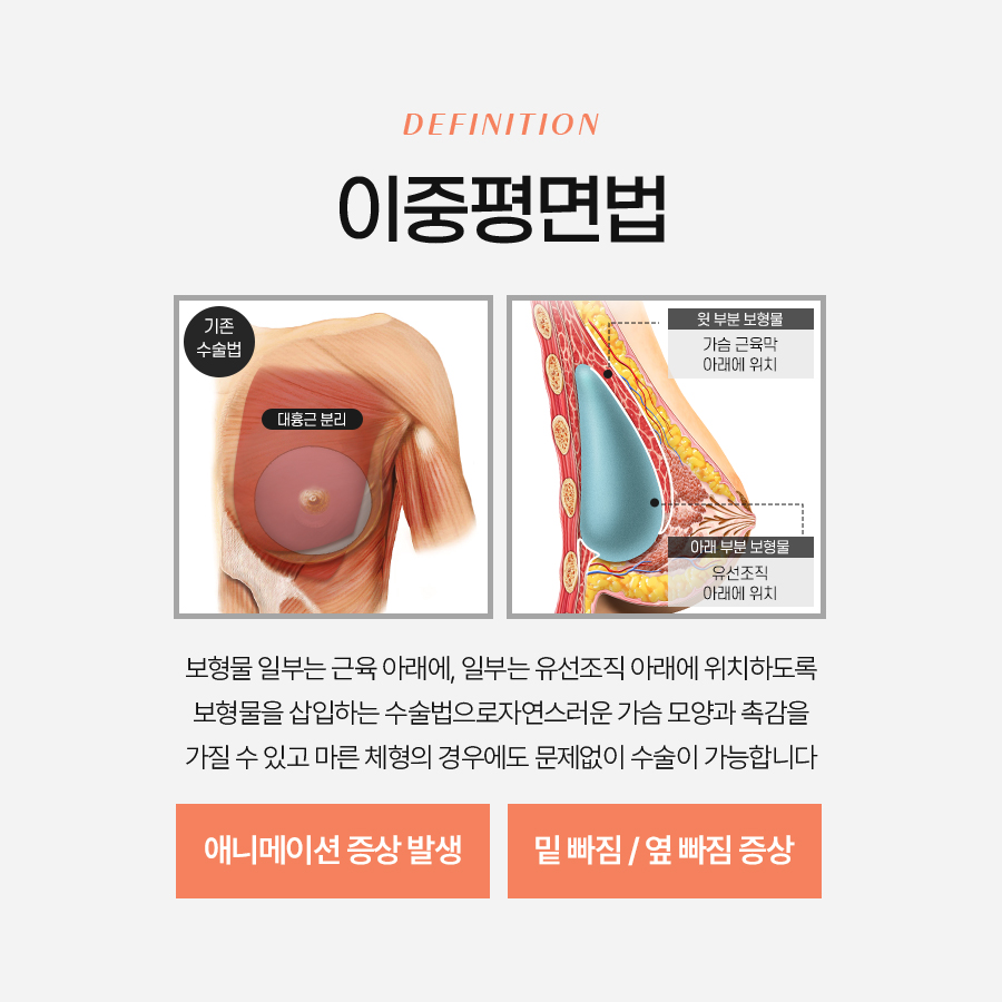 가슴구형구축원인 예방하기 위한 방법은? 관련 이미지 6