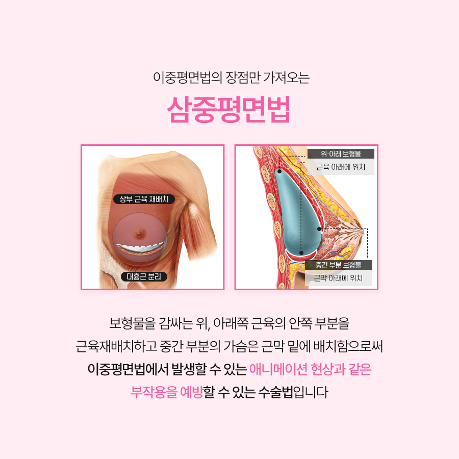 Recommended Breast Revision Surgery Clinics: Why the Triple-Plane Technique Is Drawing Attention image 4