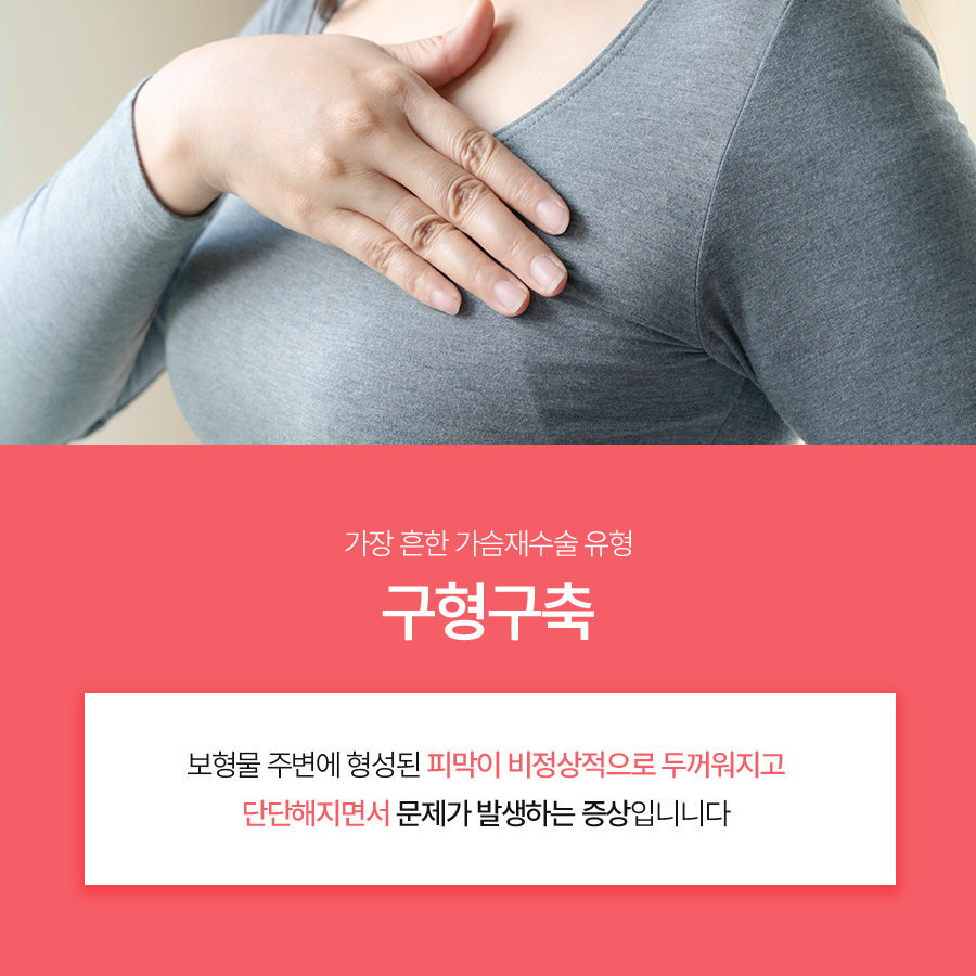 Breast Revision Surgery for Capsular Contracture: Methods Based on Symptoms and Severity image 3