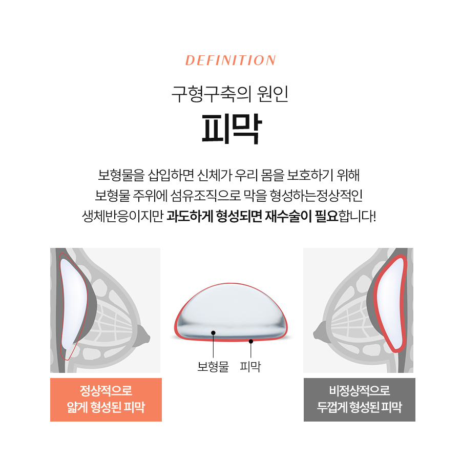 Key Points You Must Know Before Undergoing Axillary Incision Breast Revision Surgery image 4