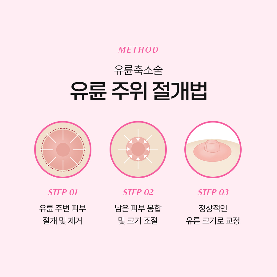 유륜축소수술방법 변화가 시작되는 기준은 무엇일까 관련 이미지 5