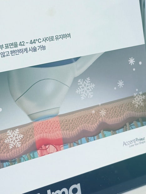 울쎄라피프라임 리프팅 효과 확인하는 관련 이미지 23