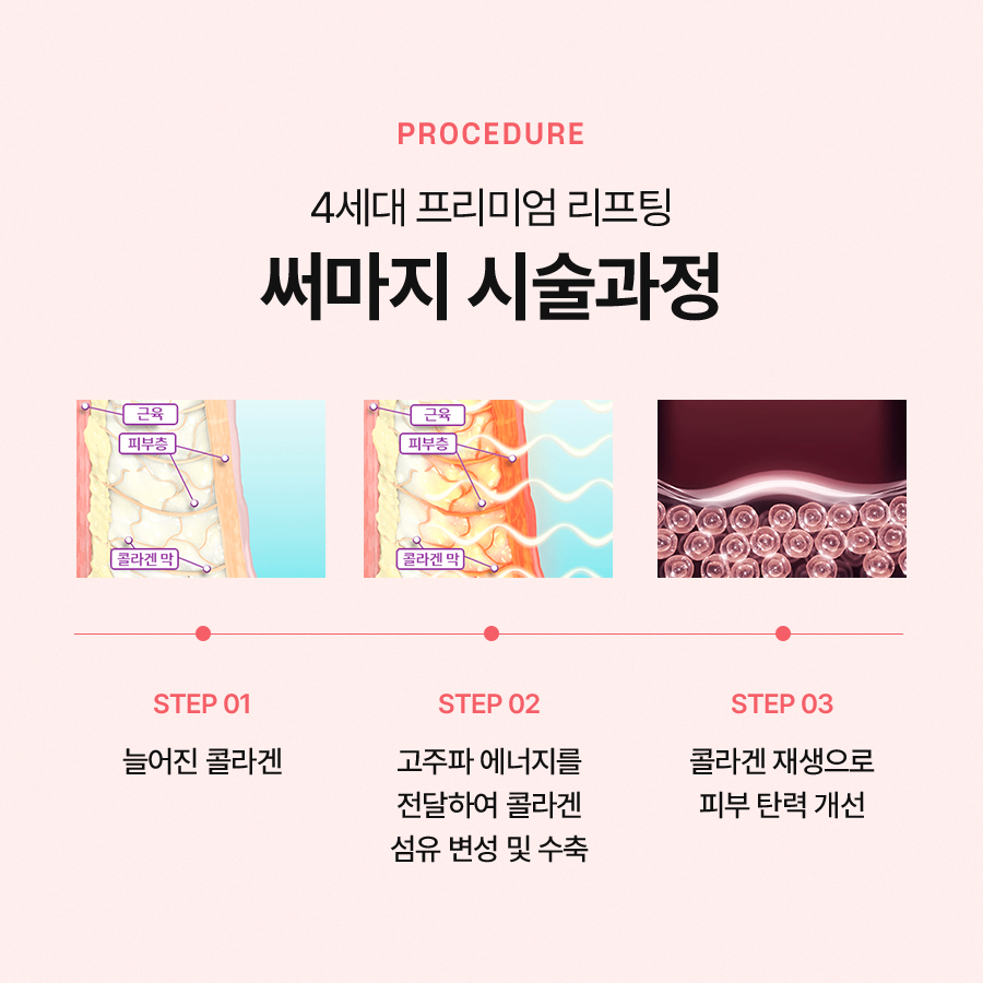 써마지 다양한 부위에 적용하여 효과를 볼 수 있습니다 관련 이미지 3