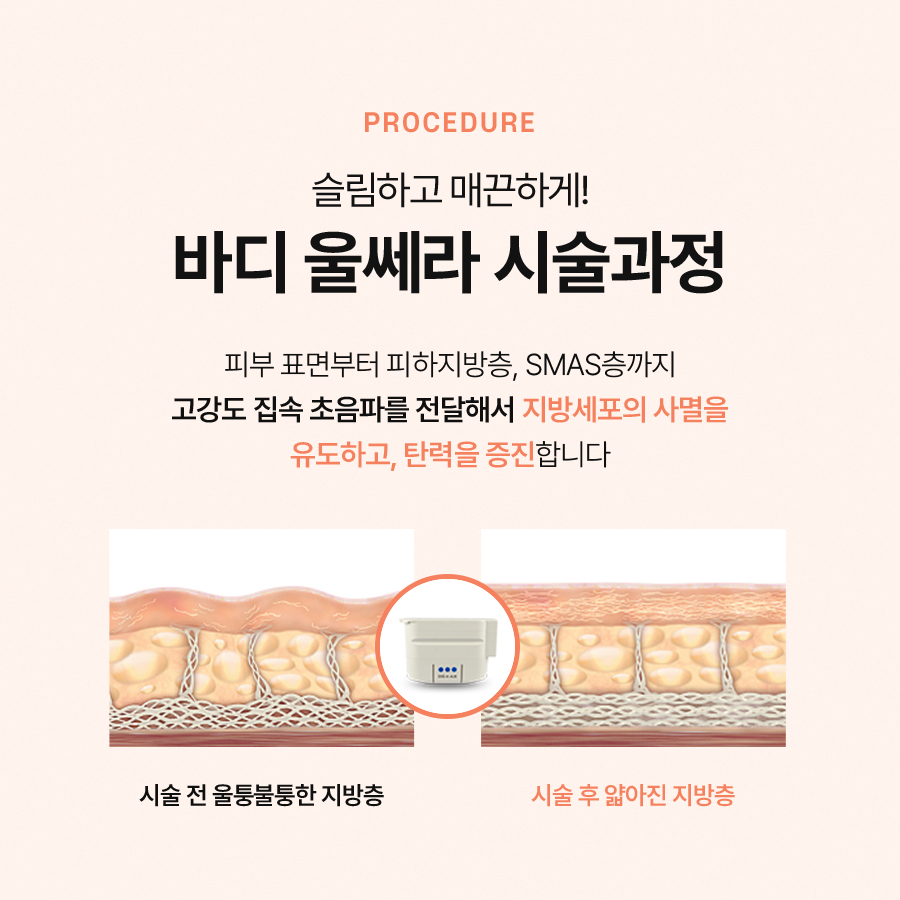 Body Ulthera Lifting for Concerns About Sagging Skin image 4