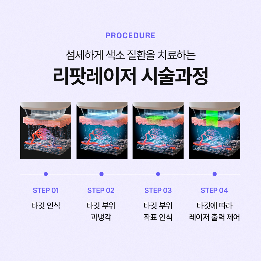 리팟레이저 얼굴 흑자를 효과적으로 제거할 수 있습니다 관련 이미지 5