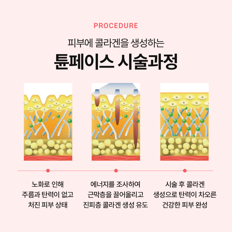 튠페이스 효과와 시술 과정을 알아본다면 관련 이미지 4